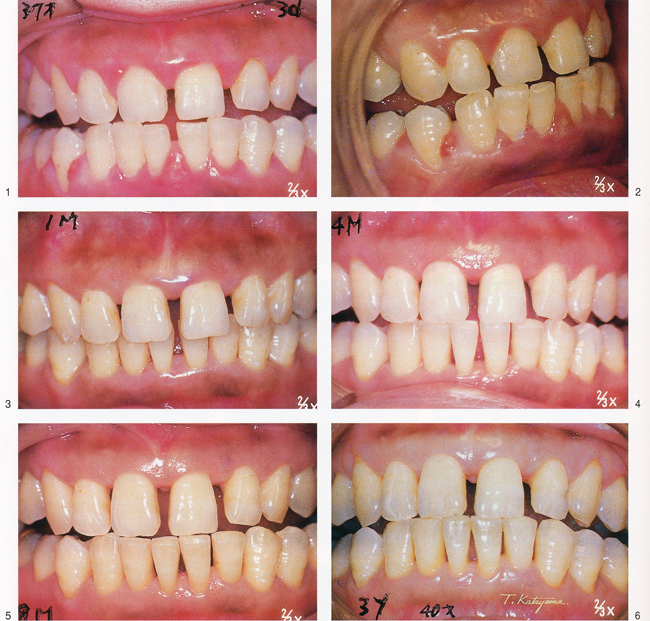 Case３　Bad breath and multiple gum abscesses
