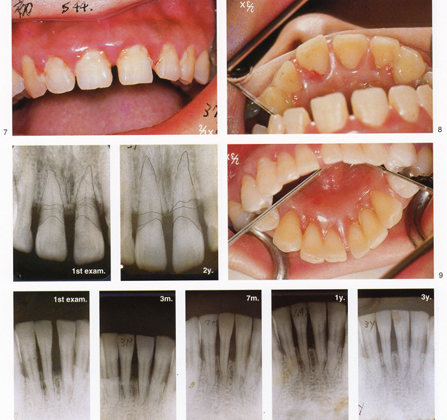 The same case　The details of the dental movement